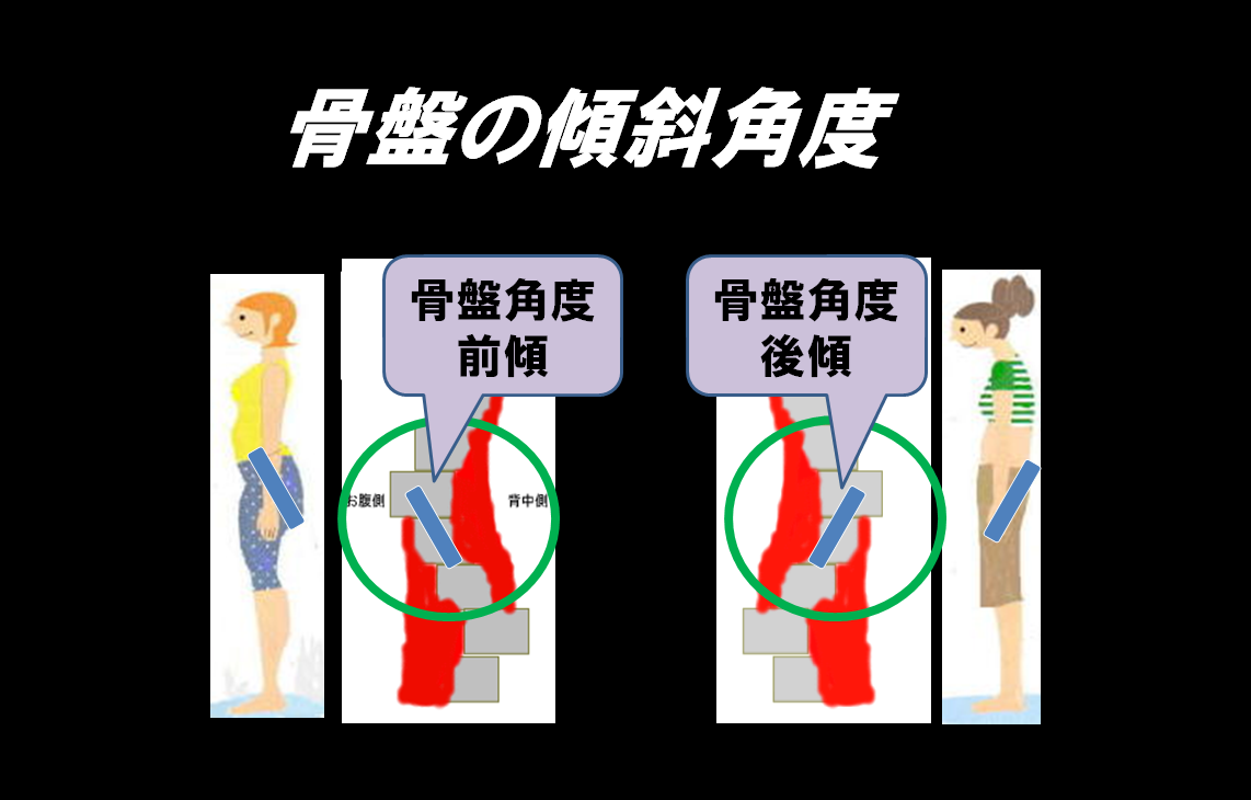 骨盤リセットする前の骨盤傾斜角度は骨盤前傾と骨盤後傾　骨盤リセットで骨盤垂直にするシセトレ｜シセトレ　姿勢トレ　ダイエット　シェイプスShapes